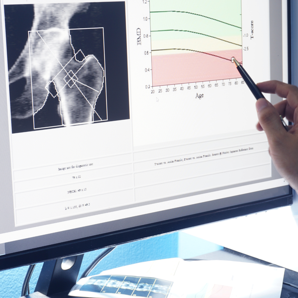 results of a bone density scan on a computer screen